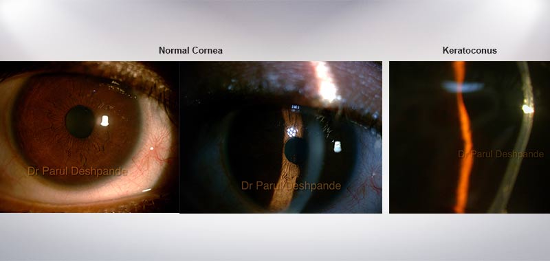 Implantarea lentilelor pentru refacerea vederii, Keratoconus | oftalmo